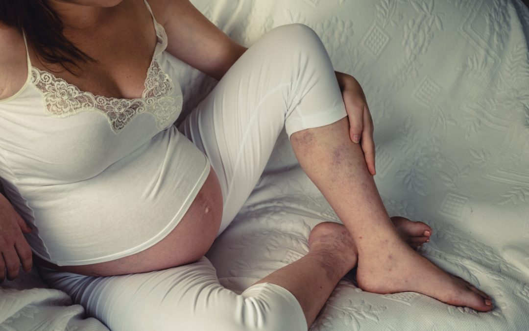 Can Being a Woman Put You at Risk for Varicose Veins